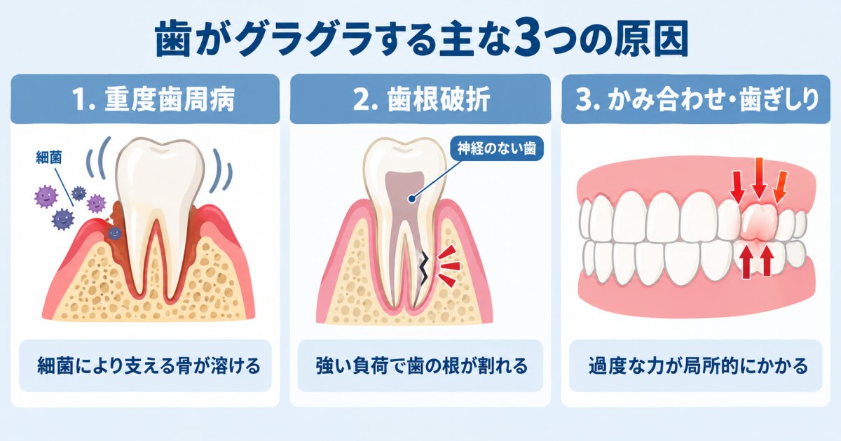 大人の歯がグラグラで抜けそうになる主な原因